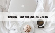 湿疹图片（湿疹图片和症状图片区别）